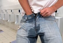 Incontinência urinária após prostatectomia robótica